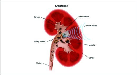 Kidney stone specialist Kolkata